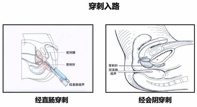 蕪湖市中醫(yī)醫(yī)院首次開展超聲引導下經(jīng)會陰前列腺穿刺(圖1)