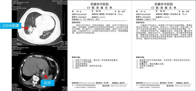 小鈦夾，威力大 ——記一例上消化道大出血患者的救治經(jīng)過(圖2)