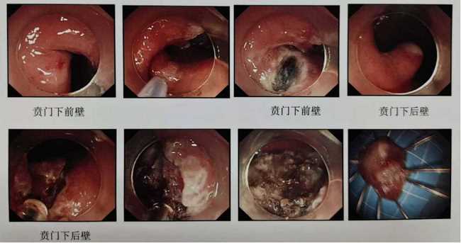 炎夏漸至，“胃腸”已碌 ——狹小的空間見證消化內(nèi)鏡微創(chuàng)手術(shù)的魅力(圖2)