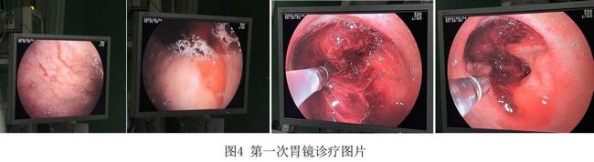 癡呆老人命懸一線，內(nèi)鏡止血彰顯奇功(圖2)