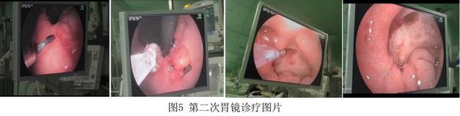 癡呆老人命懸一線，內(nèi)鏡止血彰顯奇功(圖3)