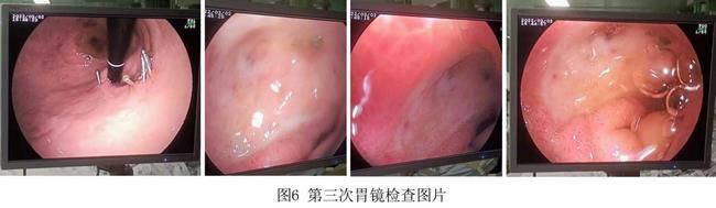 癡呆老人命懸一線，內(nèi)鏡止血彰顯奇功(圖4)