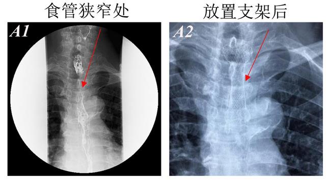 消化科運(yùn)用多學(xué)科會(huì)診（MDT）微創(chuàng)診治食管惡性腫瘤侵潤(rùn)所致食、氣道梗阻(圖4)