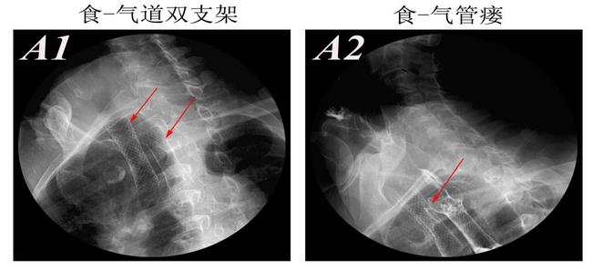 消化科運(yùn)用多學(xué)科會(huì)診（MDT）微創(chuàng)診治食管惡性腫瘤侵潤(rùn)所致食、氣道梗阻(圖8)
