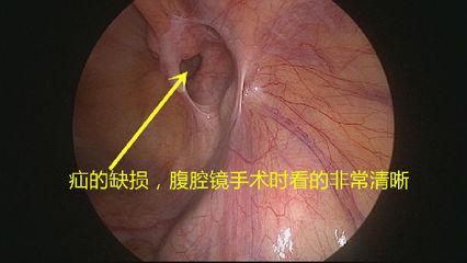 切口小，當(dāng)天即可生活自理——外三科開(kāi)展腹腔鏡下疝氣手術(shù)(圖1)