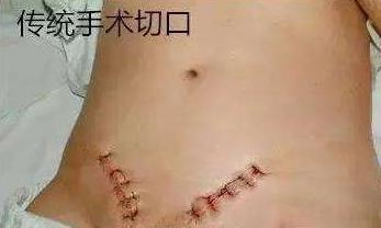 切口小，當(dāng)天即可生活自理——外三科開(kāi)展腹腔鏡下疝氣手術(shù)(圖4)